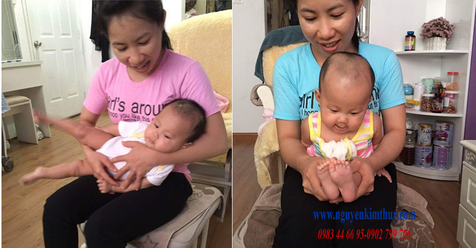 Tật vẹo cổ bẩm sinh chữa bằng bài tập vật lý trị liệu đơn giản Tật vẹo cổ bẩm sinh chữa bằng bài tập vật lý trị liệu đơn giản