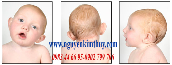 Bé bị vẹo cổ nghiêng đầu điều trị sớm hết nhanh không cần phẩu thuật Bé bị vẹo cổ nghiêng đầu điều trị sớm hết nhanh không cần phẩu thuật