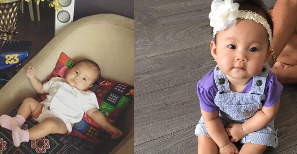 Vẹo cổ của trẻ sơ sinh chữa sớm không cần phẩu thuật, chi phí thấp Vẹo cổ của trẻ sơ sinh chữa sớm không cần phẩu thuật, chi phí thấp